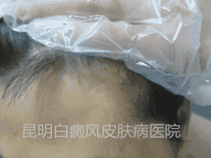 男性额头白斑一年余,在我院三个月治愈