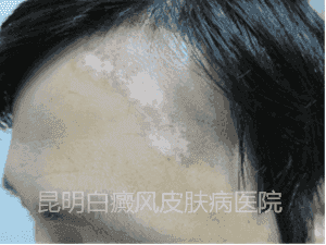 男性额头白斑一年余,在我院三个月治愈