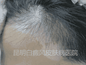 男性额头白斑一年余,在我院三个月治愈
